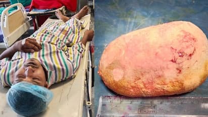 মূত্রথলিতে আধ কিলো ওজনের পেল্লাই পাথর, সফল অপারেশন জলপাইগুড়ি হাসপাতালে