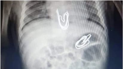 മൂന്നു മാസം പ്രായമുള്ള കുഞ്ഞിന്റെ വയറ്റില് കണ്ടെത്തിയത് കര്ട്ടന് ഹുക്കുകള്; സഹോദരി ഇട്ടതെന്ന് അമ്മ