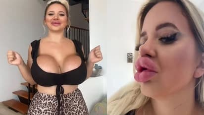 बार्बी जैसी दिखने के लिए 45 लाख किए खर्च, अब ऐसा शरीर लेकर घूम रहीं 21 साल की मैडम