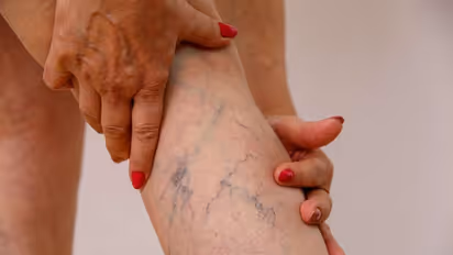 ആർത്തവവിരാമ സമയത്ത് സ്ത്രീകൾക്ക് വെരിക്കോസ് വെയിൻ ഉണ്ടാകാനുള്ള സാധ്യത കൂടുതലാണോ?