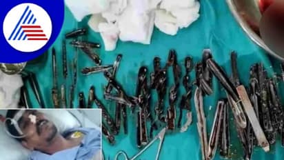 ರೋಗಿ ಹೊಟ್ಟೆಯಲ್ಲಿತ್ತು 62 ಸ್ಪೂನ್, ತಪಾಸಣೆ ಮಾಡಿದ ವೈದ್ಯರೇ ಶಾಕ್ !