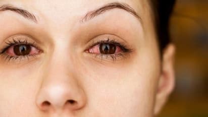 ঋতু পরিবর্তনের সঙ্গে দেখা দিচ্ছে চোখে চুলকানি ভাব, সমস্যা সমাধানে মেনে চলুন এই বিশেষ টিপস