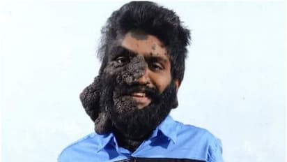 അപൂർവ രോഗത്തിനിടെ അര്ബുദവും; രോഗാവസ്ഥയ്ക്കെതിരെ മനോധൈര്യത്തോടെ പോരാടിയ പ്രഭുലാൽ പ്രസന്നൻ ഇനി ഓര്മ്മ