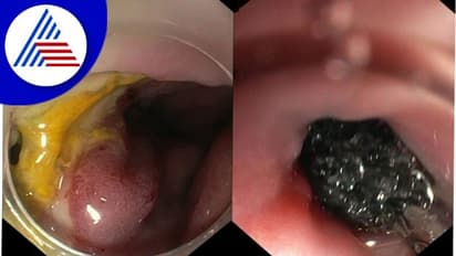 ಉಡುಪಿ: ಅಪರೂಪದ ಎಂಡೋಸ್ಕೋಪಿ ಸ್ಪಾಂಜ್ ಚಿಕಿತ್ಸೆ - ಇದು ಕರ್ನಾಟಕದಲ್ಲೇ ಮೊದಲು!