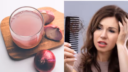 Onion Hair Pack : മുടി കൊഴിച്ചില്‍ അകറ്റാൻ സവാള കൊണ്ടുള്ള ഹെയർ പാക്കുകൾ 