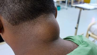 பீதியை கொடுக்கும் கொழுப்புக் கட்டிகளை கரைப்பது எப்படி..? இதை செய்யுங்க போதும்; கவலையே வேண்டாம்..!!