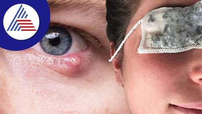  Home Medicine: ಕಣ್ಣಿನ ಸೋಂಕು ಕಡಿಮೆ ಮಾಡಲು ಮನೆಯಲ್ಲೆ ಇದೆ ಔಷಧ!