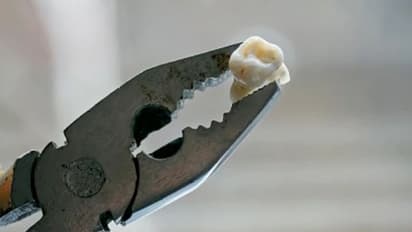 ഡോക്ടര്മാരുടെ അപ്പോയിന്മെന്റ് കിട്ടാറില്ല; 15 വര്ഷമായി സ്വയം പല്ല് പറിക്കുന്നൊരാള്