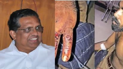 'ഭീരുവിന്‍റെ പ്രതികാരവും തിണ്ണമിടുക്കും'; പൊലീസ് മര്‍ദ്ദനത്തിനെതിരെ ഓര്‍മ്മപ്പെടുത്തലുമായി ജേക്കബ് പുന്നൂസ്