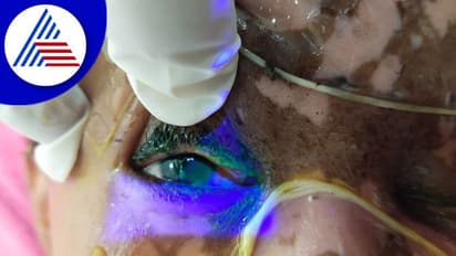 Cracker Injury: ಪಟಾಕಿ ಅವಾಂತರದಿಂದ ಸಿಲಿಕಾನ್ ಸಿಟಿಯ ಇಬ್ಬರ ಕಣ್ಣಿಗೆ ಗಾಯ