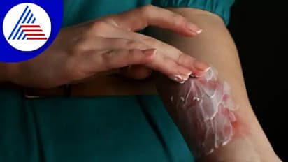 Diwali 2022: ಪಟಾಕಿ ಸುಟ್ಟ ಗಾಯ ಗುಣಪಡಿಸಲು ಸಿಂಪಲ್ ಮನೆಮದ್ದು