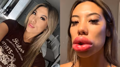 ലിപ് ഫില്ലര് ചെയ്തശേഷം ചുണ്ട് മൂന്നിരട്ടിയായി വീര്ത്തു; മുറിഞ്ഞുപോകുമോയെന്ന് ഭയന്നെന്ന് യുവതി