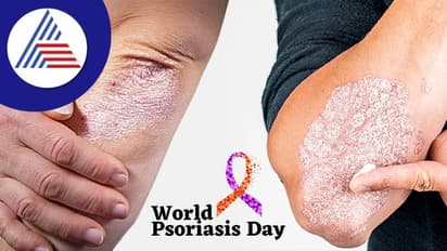 World Psoriasis Day: ದೀರ್ಘಕಾಲಿಕ ಚರ್ಮ ಕಾಯಿಲೆ ಗುರುತಿಸುವುದು ಹೇಗೆ ?