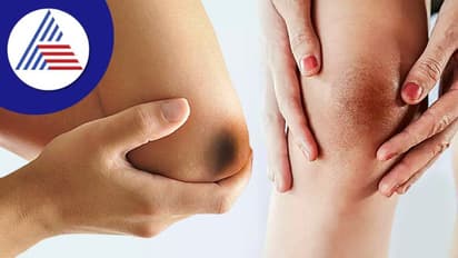 ಮೊಣಕೈ, ಮೊಣಕಾಲು ಕಪ್ಪಾಗಿದ್ದರೆ ಹೀಗ್ ಮಾಡಿ, ಸರಿ ಹೋಗುತ್ತೆ!