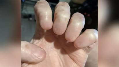 നഖങ്ങള് ഇല്ലാത്ത കയ്യുടെ ചിത്രം വൈറല്; പിന്നിലെ കാരണം ഇതാണ്...
