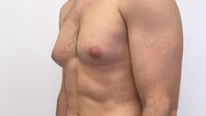 पुरुषों में स्तन क्यों निकल आते हैं? जानें इस समस्या से कैसे पाएं छुटकारा