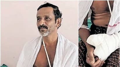 ഗൃഹനാഥന് നേരെ കാട്ടുപന്നിയുടെ ആക്രമണം, കൈവിരൽ കടിച്ചെടുത്തു