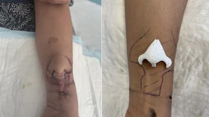 മൂക്കില്ലാതെ വര്‍ഷങ്ങള്‍ ജീവിച്ചു; ഒടുവില്‍ കയ്യില്‍ മൂക്ക് വളര്‍ത്തിയെടുത്ത് മുഖത്ത് പിടിപ്പിച്ചു