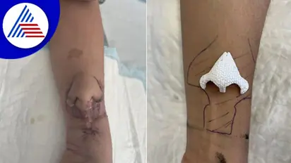 Nose Transplant: ತೋಳಿನಲ್ಲಿ ಮೂಗು ಬೆಳೆಸಿ ಮಹಿಳೆಯ ಮುಖಕ್ಕೆ ಯಶಸ್ವಿ ಕಸಿ