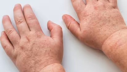 കുട്ടികളെ ബാധിക്കുന്ന 'സ്കാര്‍ലെറ്റ് ഫീവര്‍'; കേസുകള്‍ കൂടുന്നതായി യുകെയില്‍ നിന്ന് ഡോക്ടര്‍മാര്‍