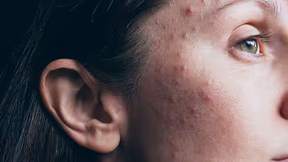 Google Lens will help you in detecting rashes, skin conditions and more; Here's how it works