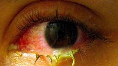 சென்னை வேகமாக பரவும் மெட்ராஸ் ஐ.. அலட்சியமாக இருந்தால் கண் பார்வை பறிபோகும் அபாயம்.. எச்சரிக்கும் மருத்துவர்.!