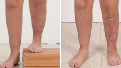 ഉയരം പോരെന്ന് അപകര്ഷത; തുടര്ന്ന് 1.2 കോടിയുടെ ശസ്ത്രക്രിയ നടത്തി