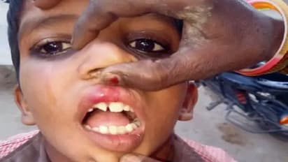 'न' ना बना पाने पर छात्र पर बर्बरता, शिक्षक ने पीट-पीटकर तोड़ा दांत, नाक से आया खून