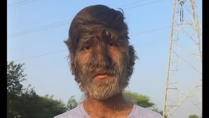 മുഖമടക്കം ശരീരം മുഴുവൻ രോമം; അപൂര്വങ്ങളില് അപൂര്വമായ രോഗവുമായി കൗമാരക്കാരൻ