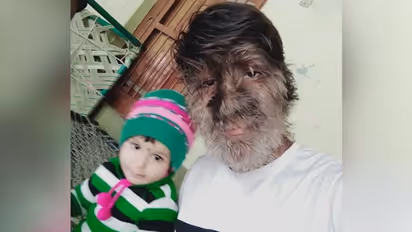MP boy diagnosed with rare 'werewolf syndrome'; Know about the disease with no cure
