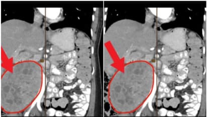 വയറുവേദനയുമായി ആശുപത്രിയിലെത്തി; 55കാരിയുടെ വയറ്റില് നിന്ന് നീക്കം ചെയ്തത് രണ്ട് കിലോ ഭാരമുള്ള മുഴ