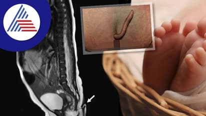 ಅಬ್ಬಬ್ಬಾ..2 ಇಂಚು ಉದ್ದದ ಬಾಲದೊಂದಿಗೆ ಜನಿಸಿದ ಹೆಣ್ಣು ಮಗು