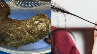 தலைமுடியை கடித்து சாப்பிடும் விநோத பழக்கம் ஏற்படுவது ஏன்..?