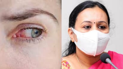 ചെങ്കണ്ണ് ശ്രദ്ധിച്ചില്ലെങ്കില് സങ്കീര്ണമാവാം, കുട്ടികള്ക്ക് കൂടുതല് കരുതല് വേണം; ആരോഗ്യമന്ത്രി