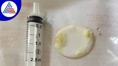 8 ತಿಂಗಳ ಮಗುವಿನ ಗಂಟಲಲಿತ್ತು ಬಾಟಲ್‌ ಮುಚ್ಚಳ: ಫೊರ್ಟಿಸ್‌ ಆಸ್ಪತ್ರೆ ವೈದ್ಯರಿಂದ ಯಶಸ್ವಿ ಚಿಕಿತ್ಸೆ