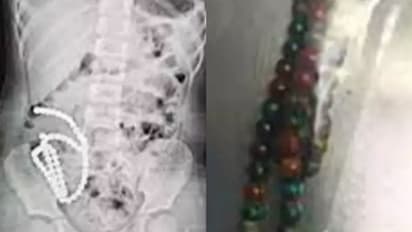 നാലു വയസുകാരിയുടെ വയറില് നിന്ന് നീക്കം ചെയ്തത് 61 മാഗ്നറ്റിക് മുത്തുകള്