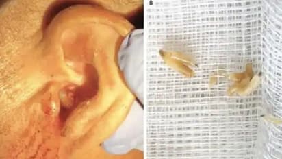 വേദനയും ചൊറിച്ചിലുമായി ആശുപത്രിയിലെത്തിയ രോഗിയുടെ ചെവിയില് നിന്ന് കണ്ടെത്തിയത്...