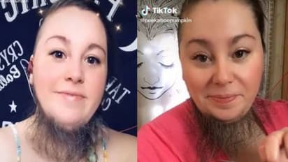 താടിരോമം വളർന്നതിന് പരിഹസിക്കപ്പെട്ടു, അന്ന് വേദനിച്ചു, എന്നാൽ ഇന്ന്...