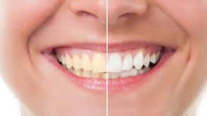 വെറും മൂന്ന് ചേരുവകള്‍ കൊണ്ട് പല്ലുകളുടെ മഞ്ഞ നിറം മാറ്റാം; വീഡിയോ 