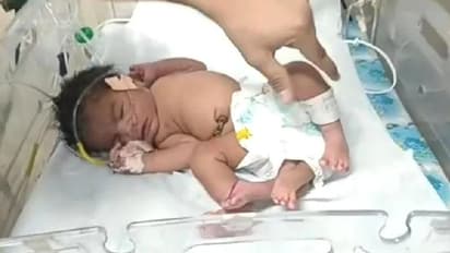 अनोखी बच्ची जन्मी: देखने पहुंच रही भीड़, डॉक्टर बोले-लाखों में एक होते हैं ऐसे बच्चे, लेकिन मां बहा रही आंसू