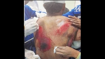 எலும்பியல் மற்றும் பிளாஸ்டிக் அறுவை சிகிச்சை நிபுணர்களின் கண்காணிப்பில் ரிஷப் பண்ட்: டேராடூன் மருத்துவர் ஆஷிஸ்