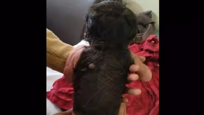 ശരീരത്തിലെ 60 ശതമാനവും മറുകും രോമവുമായി കുഞ്ഞ് പിറന്നു; ഇത് അപൂര്‍വമായ അവസ്ഥ