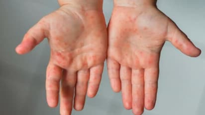 അഞ്ചാംപനി; ലക്ഷണങ്ങളും ശ്രദ്ധിക്കേണ്ട കാര്യങ്ങളും...