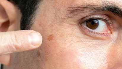 മുഖത്തെ കറുത്ത പാടുകള്‍ മാറ്റാന്‍ വീട്ടില്‍ പരീക്ഷിക്കാം ഈ നാല് ഫേസ് പാക്കുകള്‍...