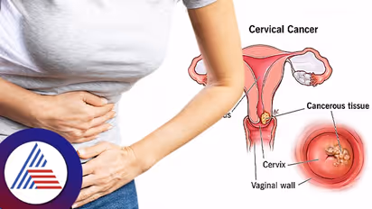 Cervical Cancer: Steps women can take to reduce risk of cervical cancer