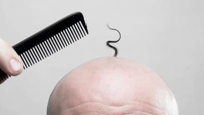 ಬೋಳುತಲೆ ಎಂದು ಕೆಲಸ ತೊರೆಯುವಂತೆ ಒತ್ತಡ: ಸಂಸ್ಥೆಯಿಂದ 71 ಲಕ್ಷ ಪರಿಹಾರ ಗೆದ್ದ ಉದ್ಯೋಗಿ