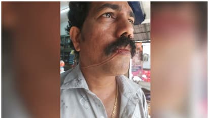 മരണക്കുരുക്കായി കേബിൾ,  കൊച്ചിയിൽ വീണ്ടും കേബിൾ കുരുങ്ങി അപകടം, ബൈക്ക് യാത്രക്കാരന് പരിക്ക് 