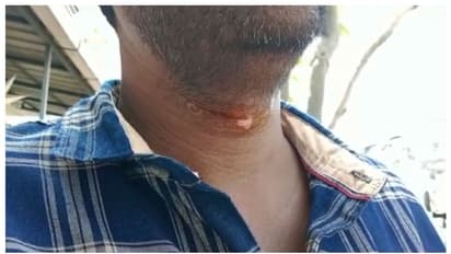 കൊച്ചിൻ കാർണിവലിനായി കെട്ടിയ തോരണം കഴുത്തില് കുടുങ്ങി, ബൈക്ക് യാത്രക്കാരന് പരിക്ക്