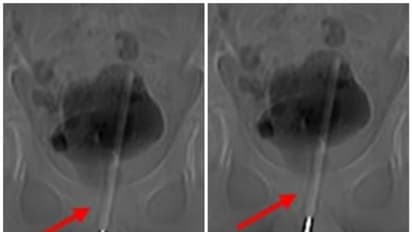 അമ്പരന്ന് ഡോക്ടർമാർ...! 12 വയസ്സുകാരന്റെ മൂത്രാശയത്തിൽ നിന്ന് പുറത്തെടുത്തത് തെർമോമീറ്റർ