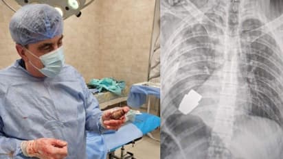 ഏത് നിമിഷവും പൊട്ടാവുന്ന ഗ്രനേഡ് ശസ്ത്രക്രിയയിലൂടെ  പുറത്തെടുത്ത് യുക്രൈന്‍ ഡോക്ടര്‍! 